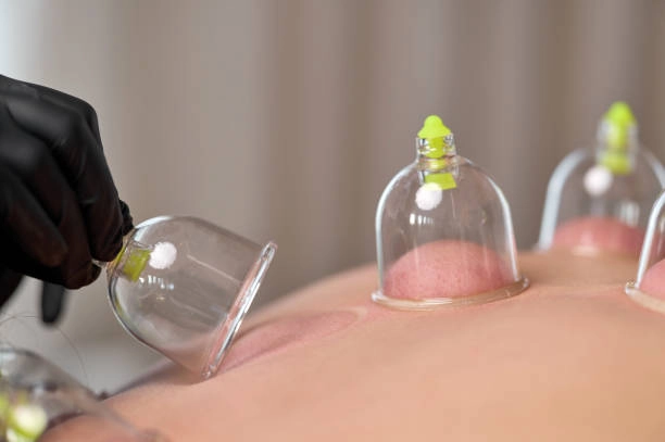 My clients gladly tell me how traditional cupping in St. Louis has changed their lives.