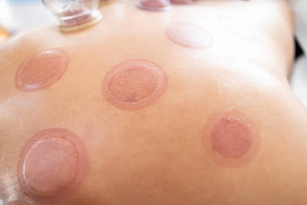 Professional cupping therapy in ST. Louis