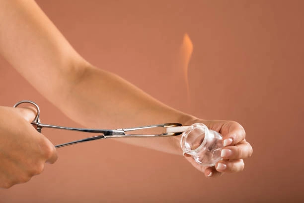 cupping therapy is usually harmless